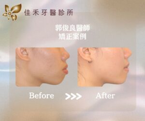 郭俊良醫師矯正案例