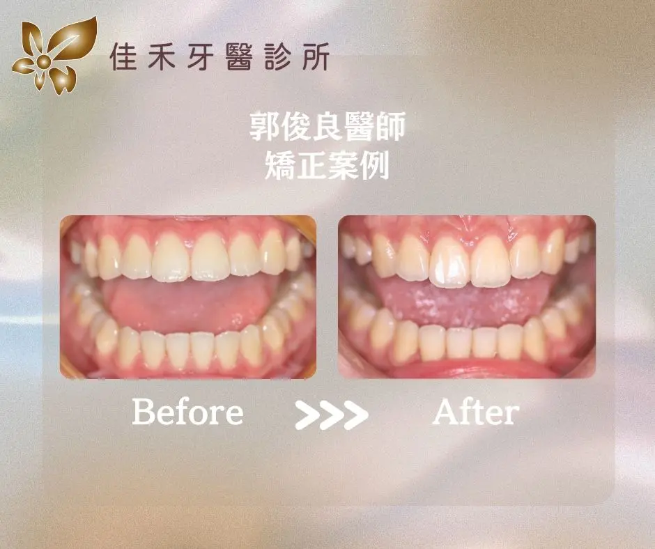 <案例分享>矯正案例分享-郭俊良醫師 2 郭俊良醫師矯正案例