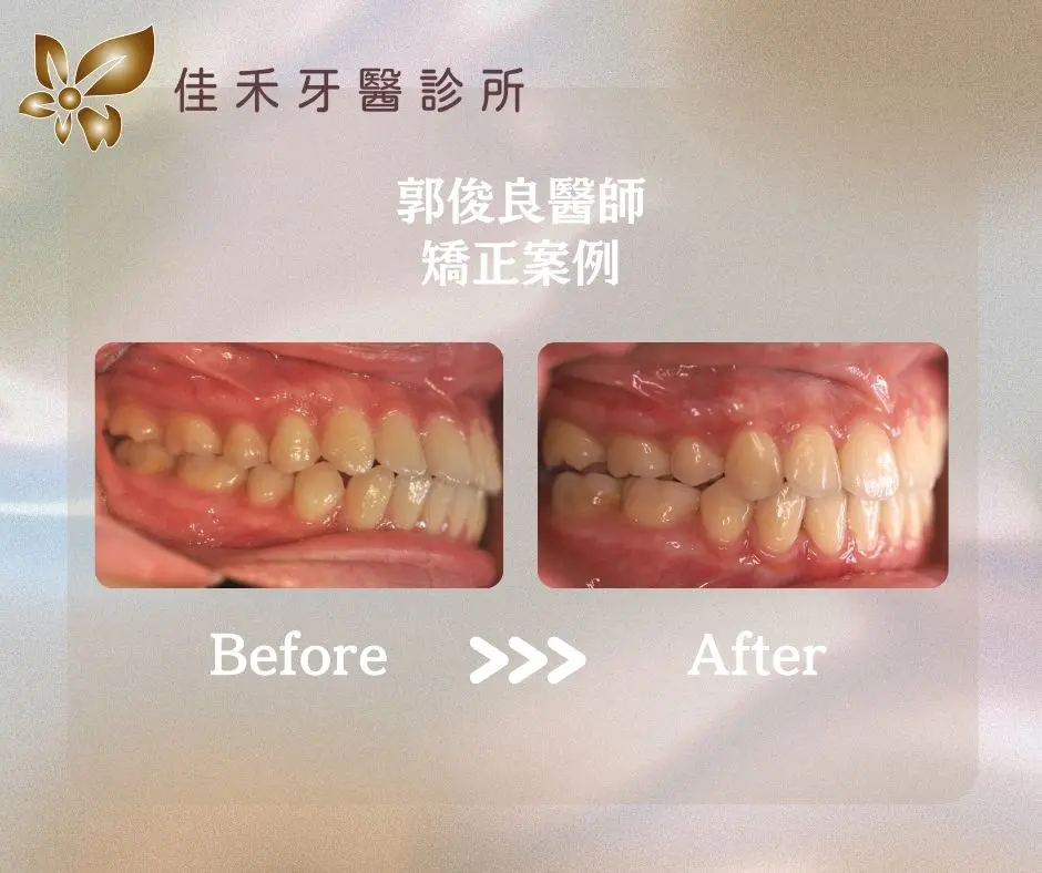 <案例分享>矯正案例分享-郭俊良醫師 3 郭俊良醫師矯正案例