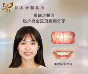 張齡之醫師貼片與全瓷冠案例分享