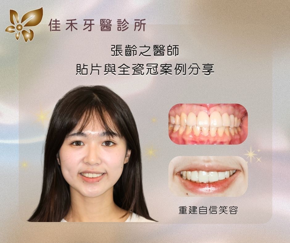 張齡之醫師貼片與全瓷冠案例分享