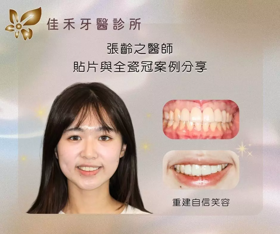 張齡之醫師貼片與全瓷冠案例分享