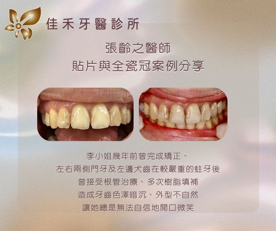 案例分享|貼片與全瓷冠案例分享-張齡之醫師 2 張齡之醫師貼片與全瓷冠案例分享