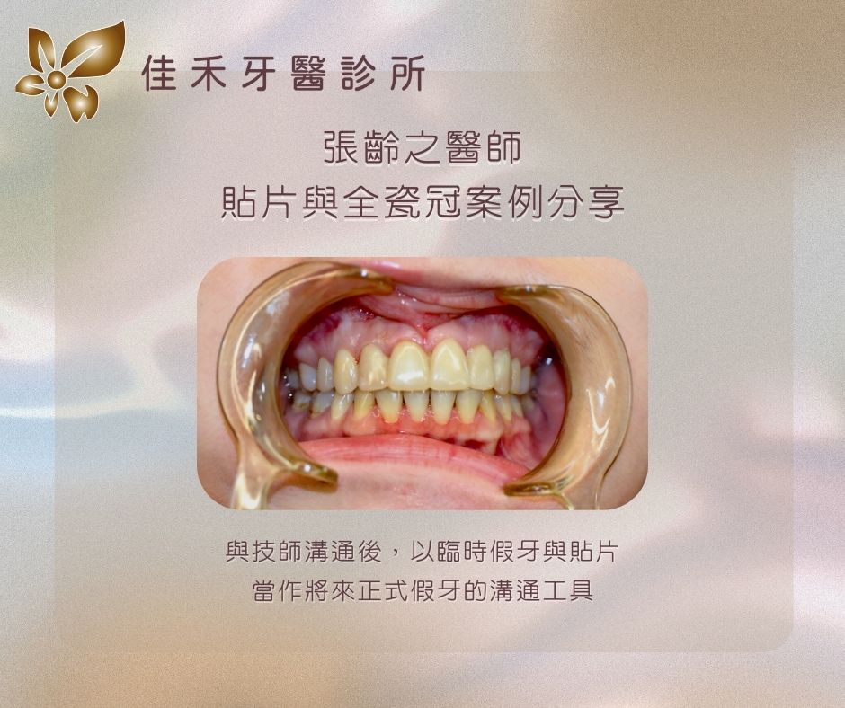 案例分享|貼片與全瓷冠案例分享-張齡之醫師 3 張齡之醫師貼片與全瓷冠案例分享