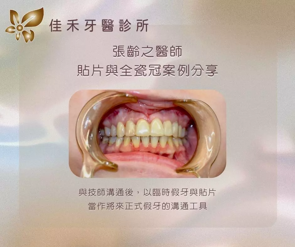 張齡之醫師貼片與全瓷冠案例分享