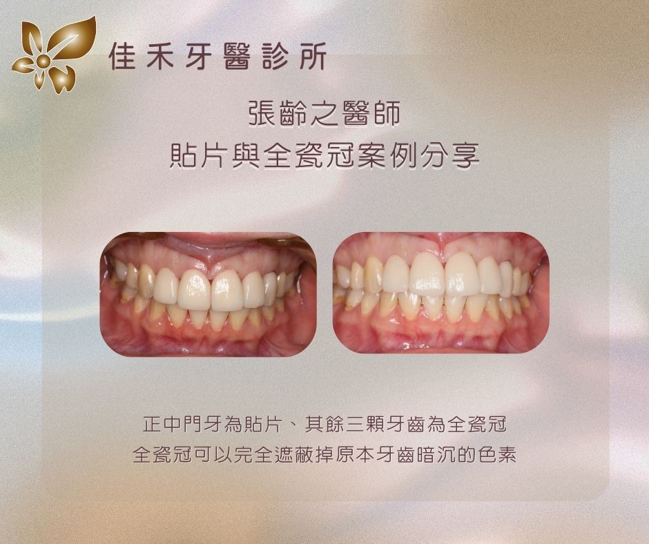案例分享|貼片與全瓷冠案例分享-張齡之醫師 4 張齡之醫師貼片與全瓷冠案例分享