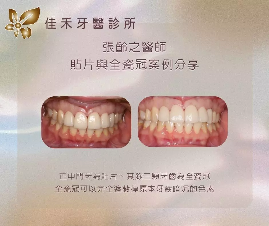 張齡之醫師貼片與全瓷冠案例分享