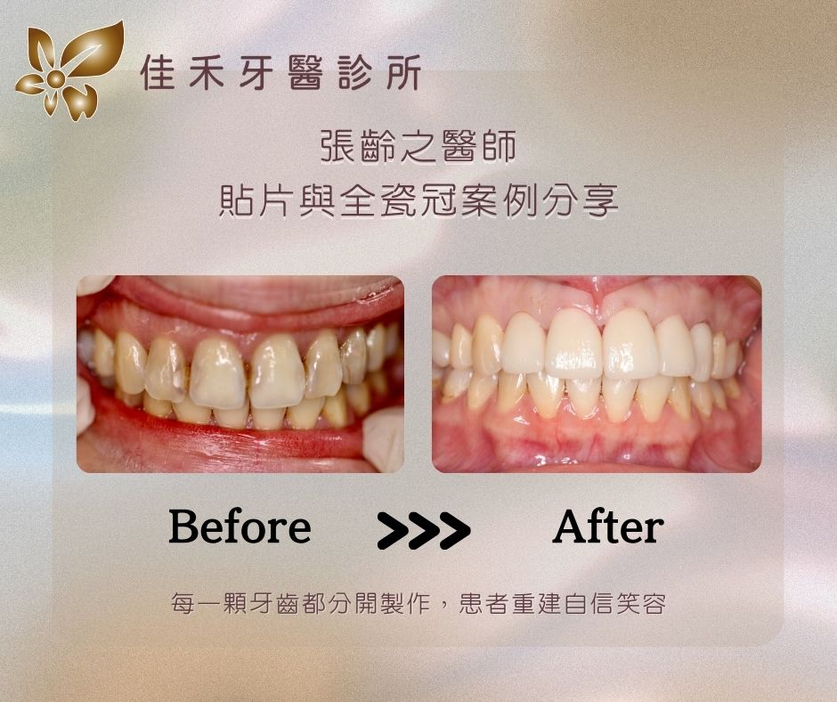 案例分享|貼片與全瓷冠案例分享-張齡之醫師 5 張齡之醫師貼片與全瓷冠案例分享