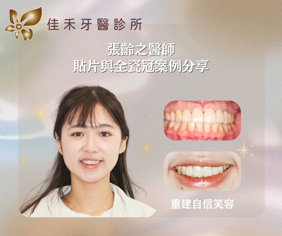 <案例分享>貼片與全瓷冠案例分享-張齡之醫師 1 張齡之醫師貼片與全瓷冠案例分享