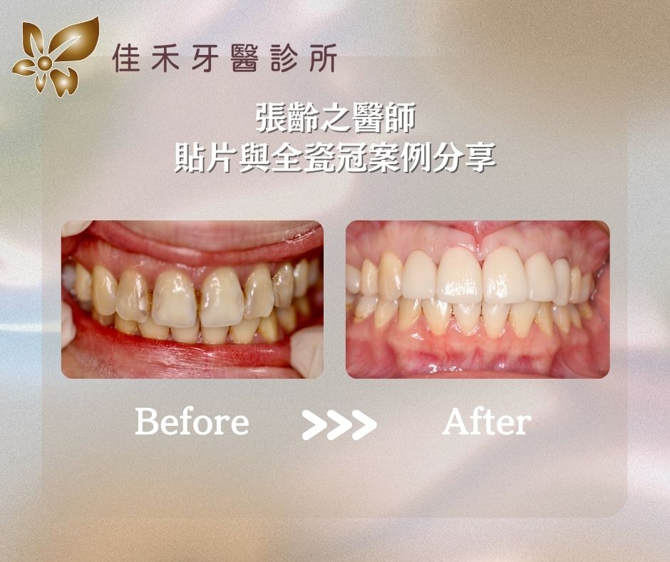 <案例分享>貼片與全瓷冠案例分享-張齡之醫師 2 張齡之醫師貼片與全瓷冠案例分享