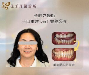 半口重建5 in 1案例分享-張齡之醫師