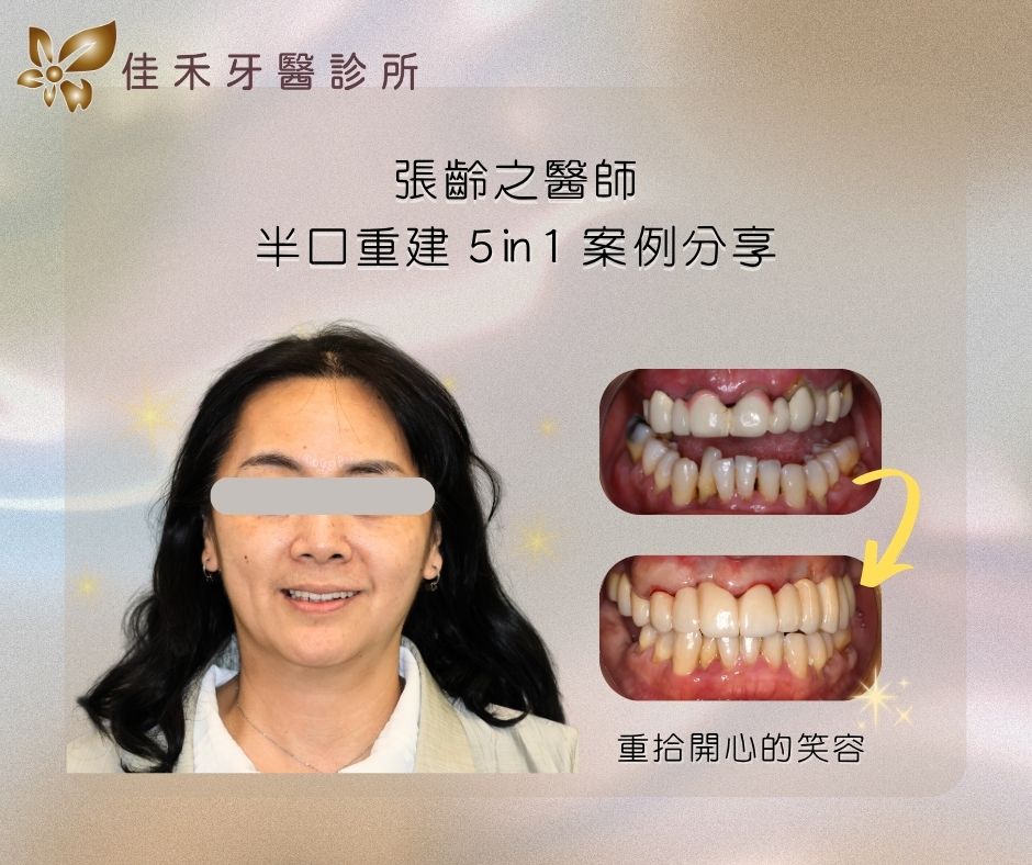案例分享|半口重建5 in 1案例分享-張齡之醫師 1 張齡之醫師半口重建5in1案例分享
