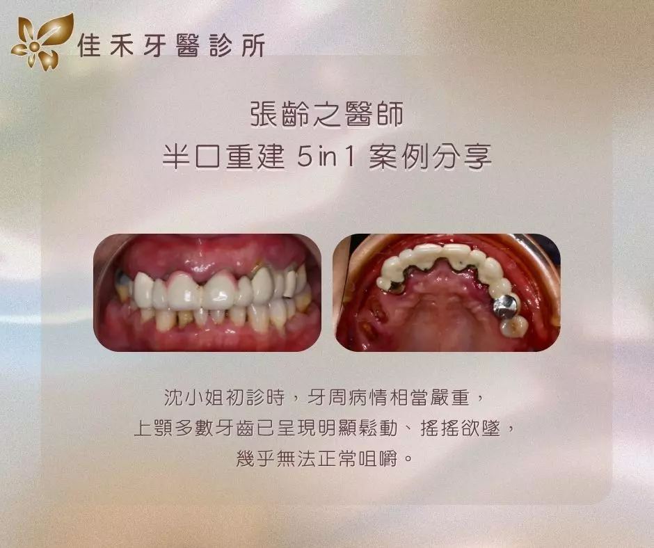 張齡之醫師半口重建5in1案例分享