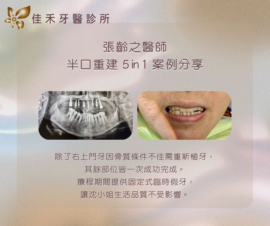 案例分享|半口重建5 in 1案例分享-張齡之醫師 3 張齡之醫師半口重建5in1案例分享