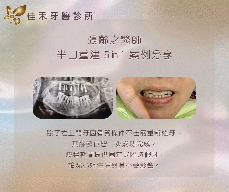 張齡之醫師半口重建5in1案例分享