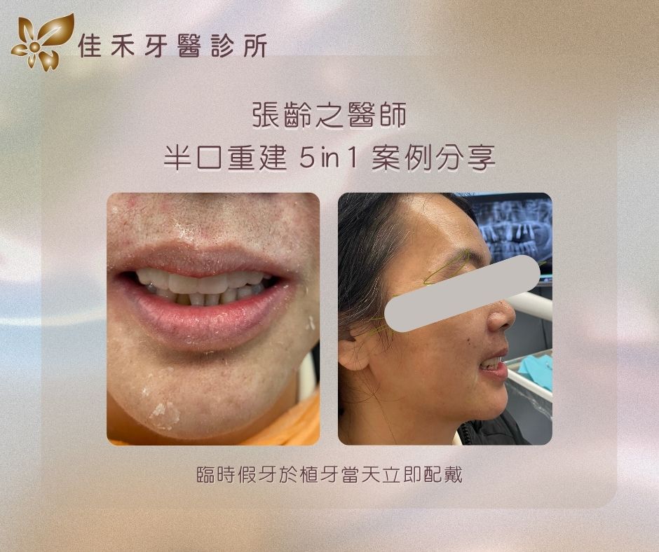 案例分享|半口重建5 in 1案例分享-張齡之醫師 4 張齡之醫師半口重建5in1案例分享