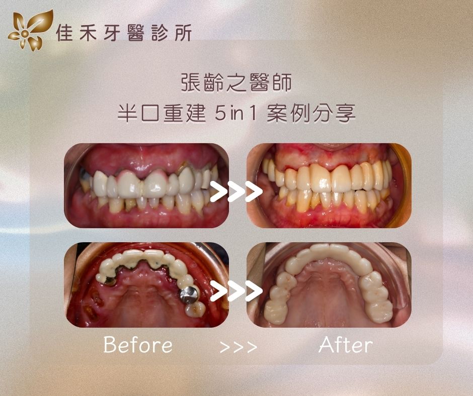 案例分享|半口重建5 in 1案例分享-張齡之醫師 5 張齡之醫師半口重建5in1案例分享
