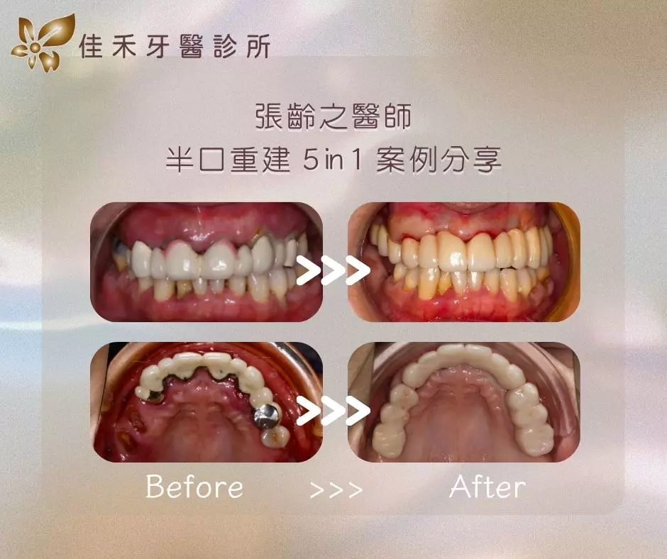 張齡之醫師半口重建5in1案例分享