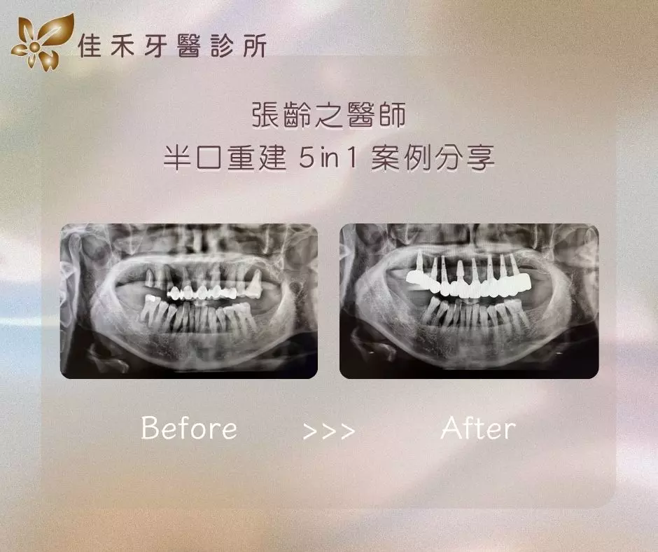 張齡之醫師半口重建5in1案例分享