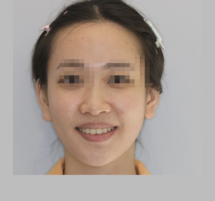 治療後正面照片，已調整頭部尺寸與位置，雙眼已像素化遮蔽