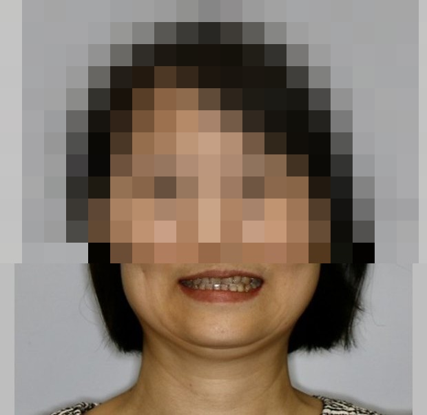 治療前正面笑容，鼻子及以上已馬賽克遮蔽