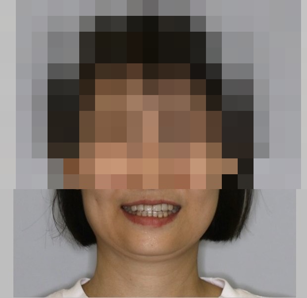 治療後正面笑容，鼻子及以上已馬賽克遮蔽